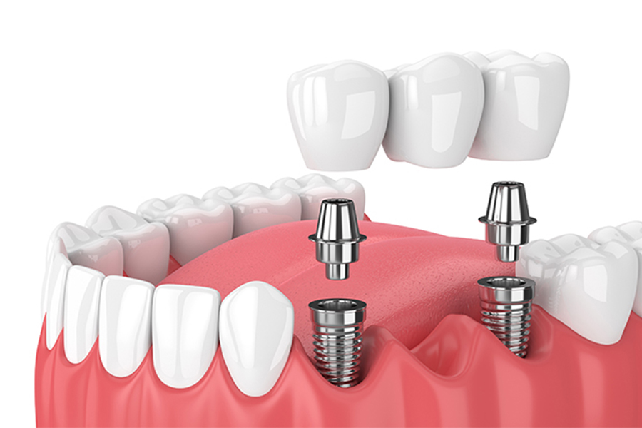 インプラント治療について